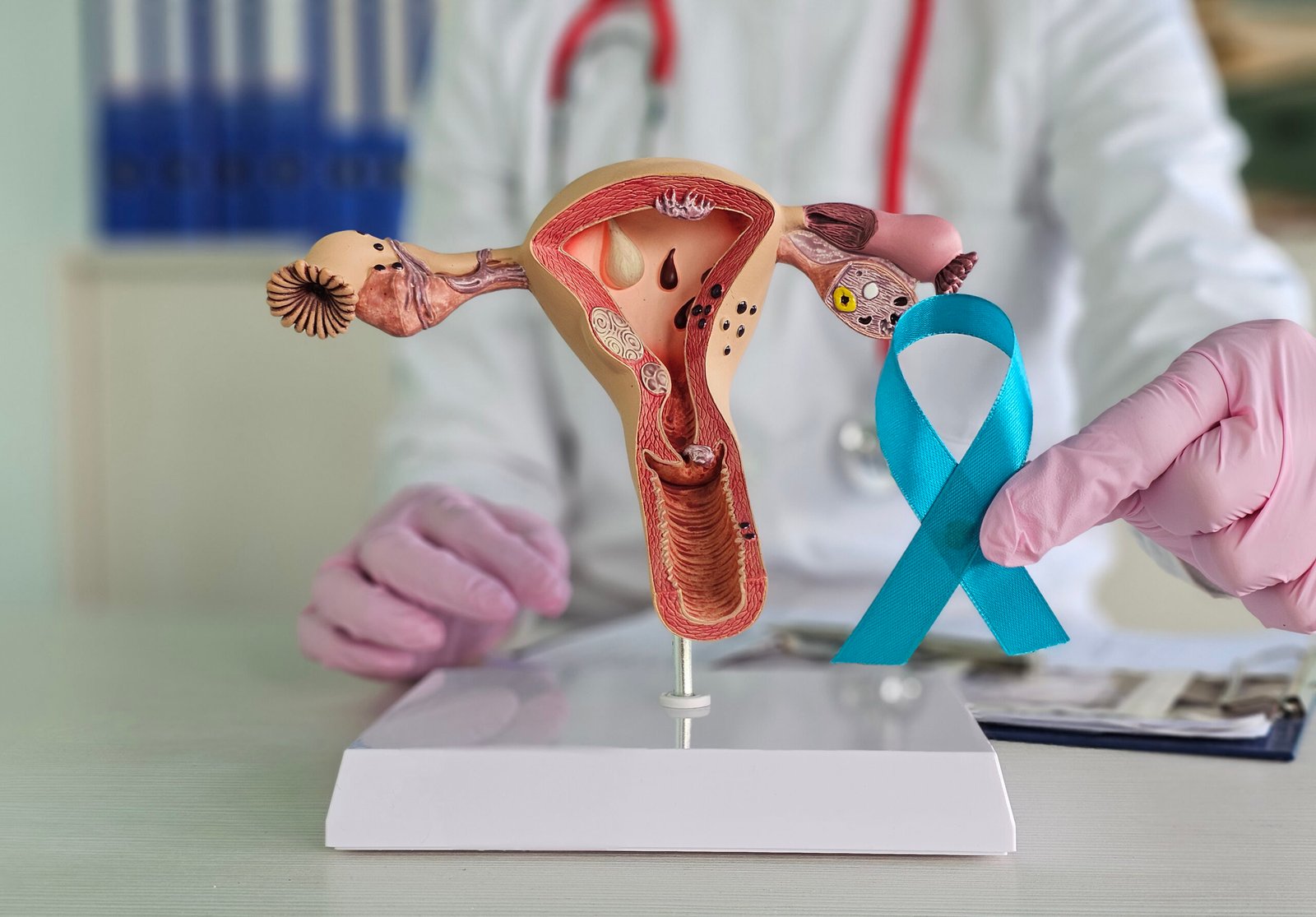 Cáncer de cuello uterino: síntomas, causas y prevención